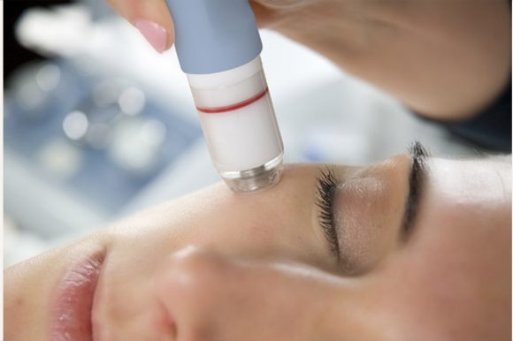 MicroDermabrasion